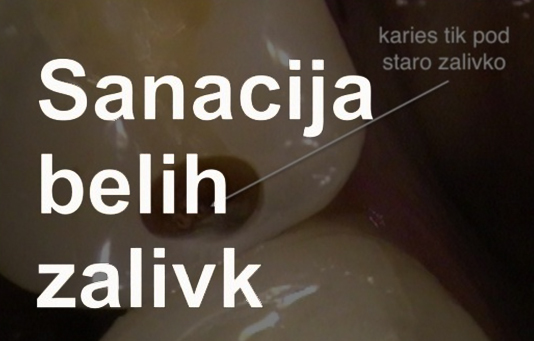 Sanacija belih zalivk